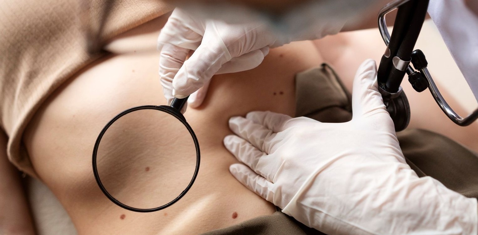 Câncer de pele: tudo o que você precisa saber